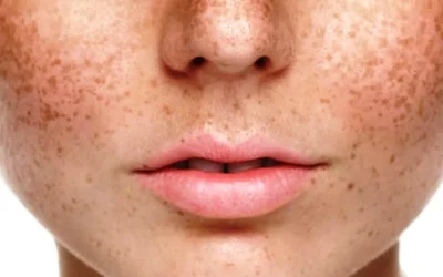 5 Cara Menghilangkan Bintik Hitam di Wajah dengan Bahan Alami