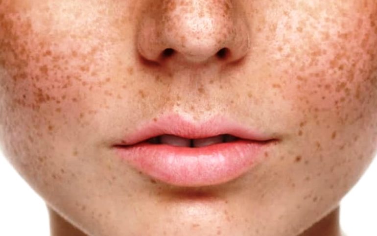 Cara Menghilangkan Bintik Hitam di Wajah dengan Bahan Alami