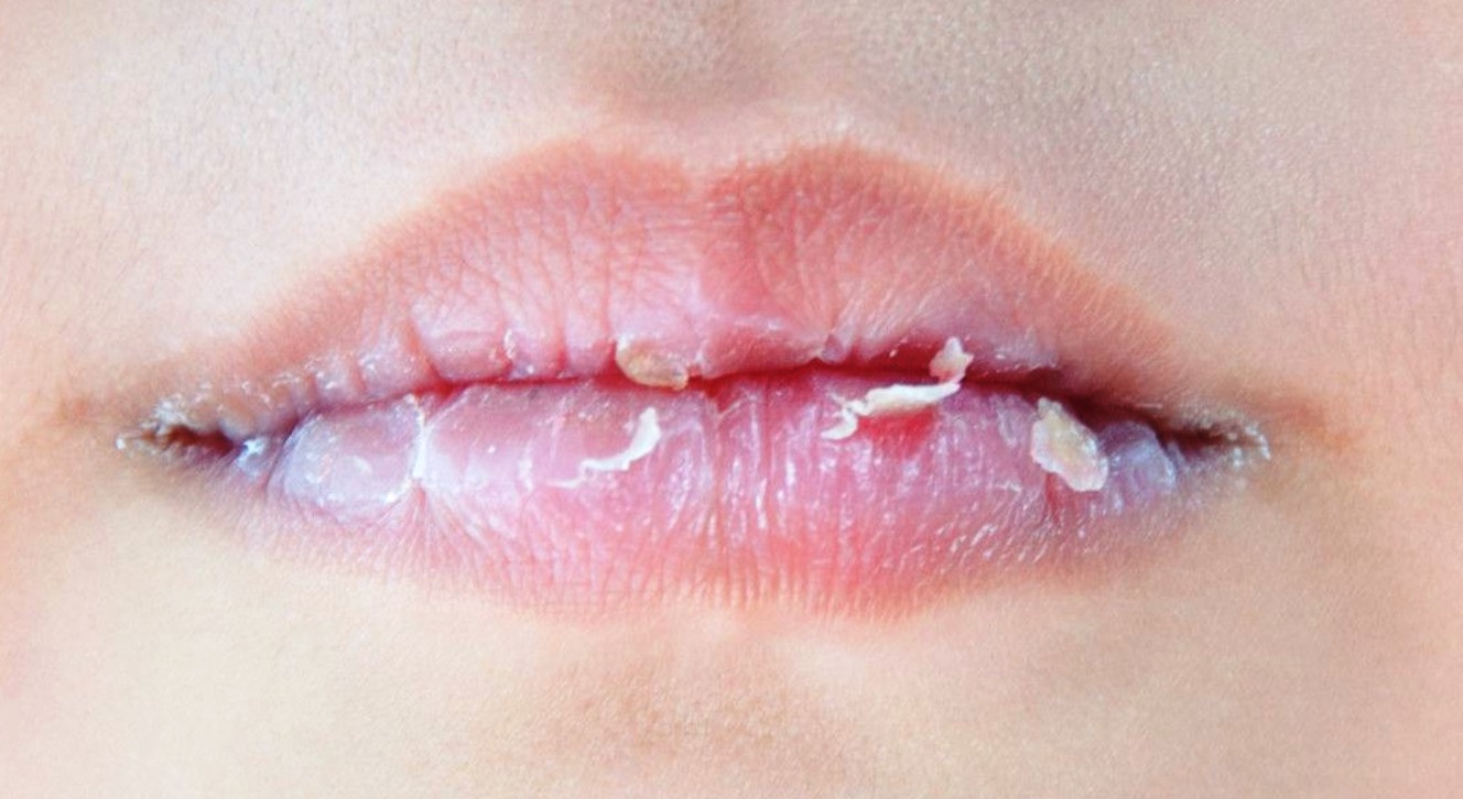 8 Tips Mengatasi Bibir Kering dan Mengelupas secara Alami, Mudah Dilakukan